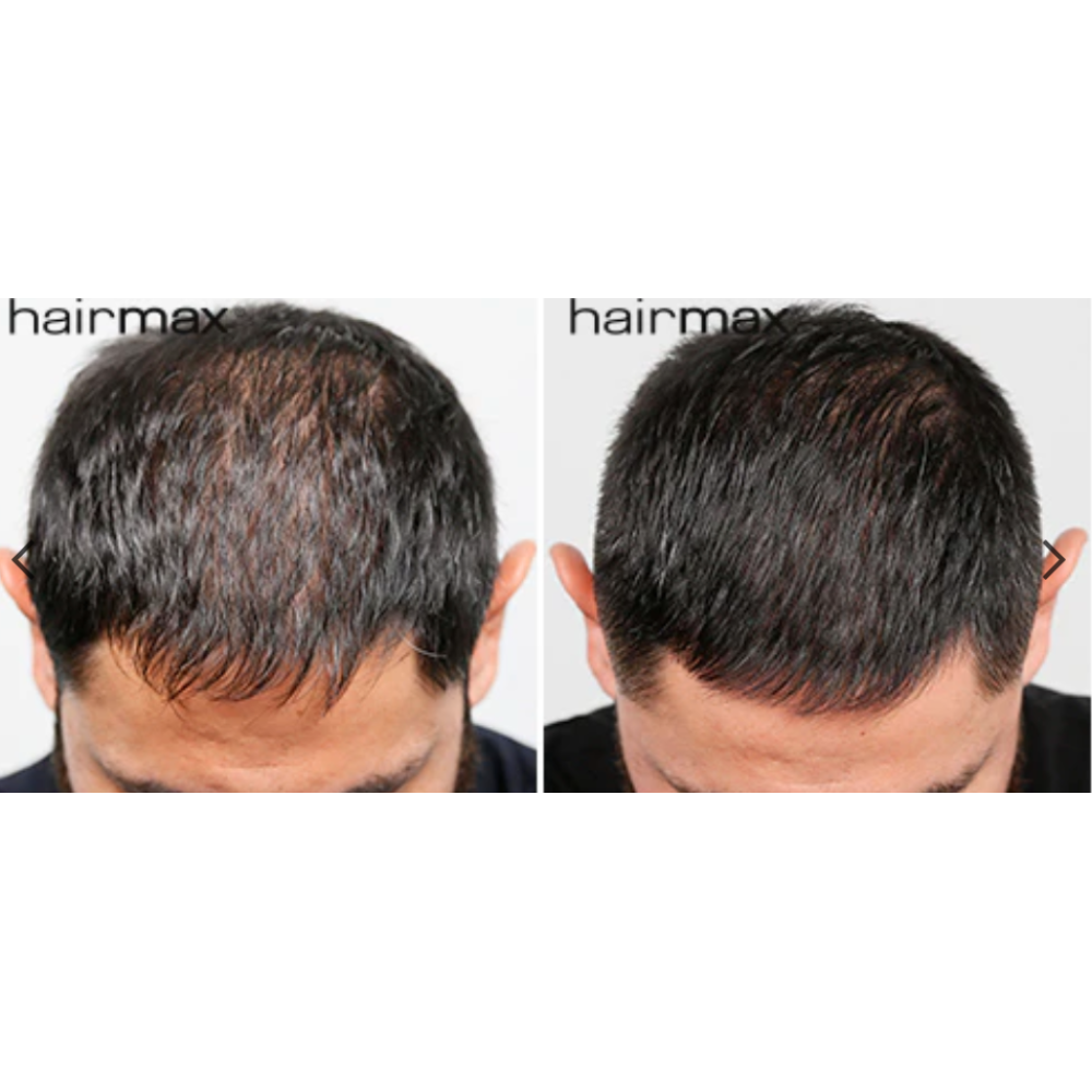 HairMax LaserBand 82 - ComfortFlex lazerinė šukų juosta, rožinio aukso (16970-rose-gold)