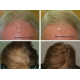 HairMax LaserCap 272 PowerFlex – lazerinė kepurė (LASER 272)