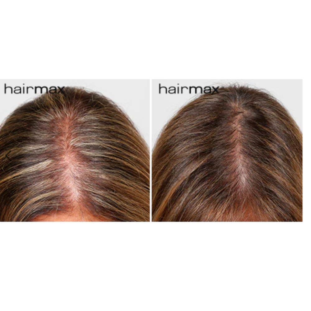 HairMax LaserBand 82 - ComfortFlex lazerinė šukų juosta, rožinio aukso (16970-rose-gold)