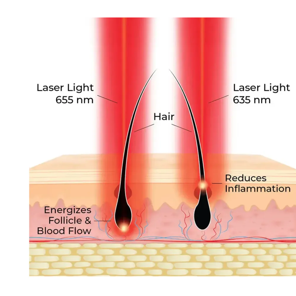 HairMax ACTONIS™ 18 dvigubos veiklos lazerinės šukos