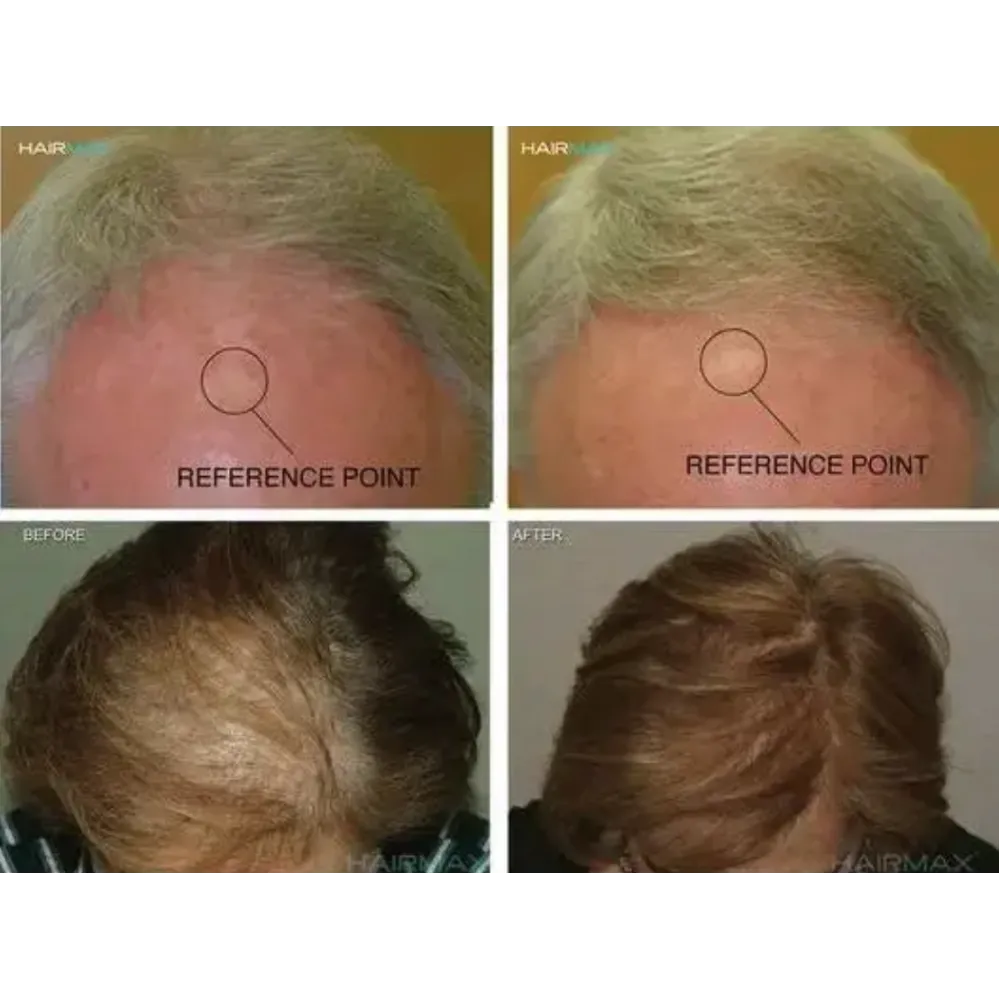 HairMax LaserCap 272 PowerFlex – lazerinė kepurė